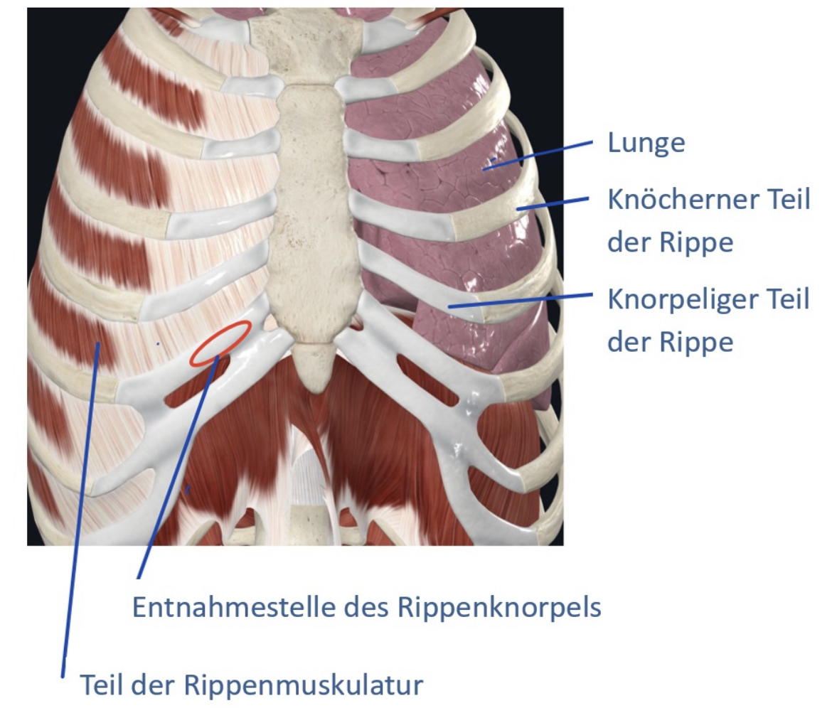 Nasenoperation - Position der Rippen- und Muskelentnahme