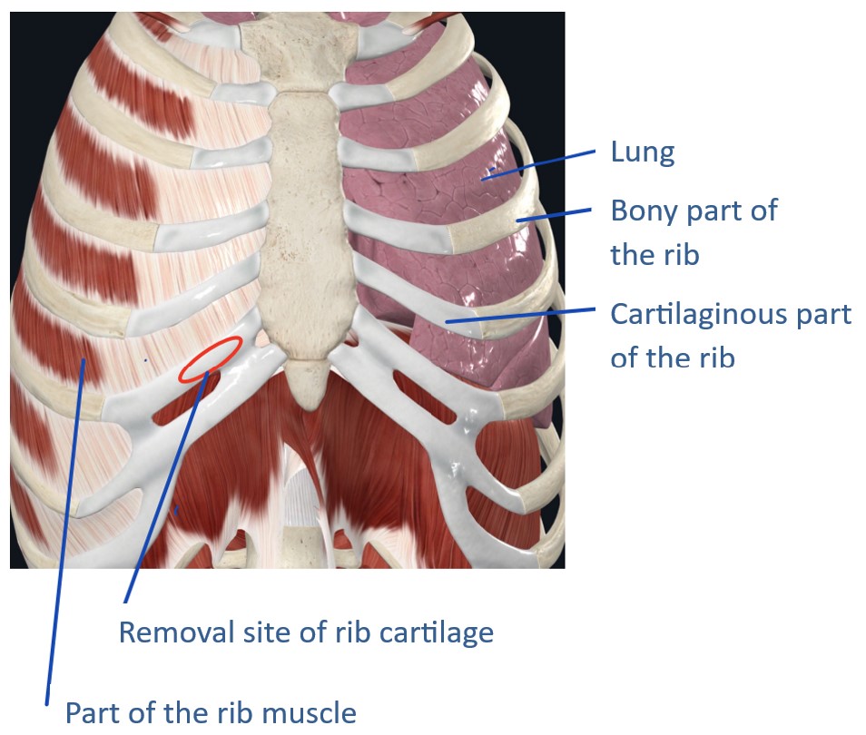 Rib and muscle removal for rhinoplasty